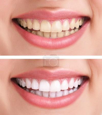 healthy teeth and smile