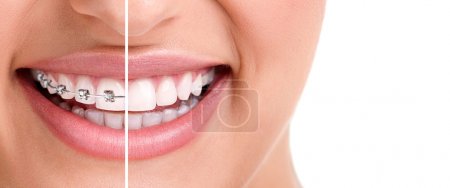 Healthy smile with braces